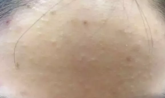 去除粉刺的注意事項有哪些？