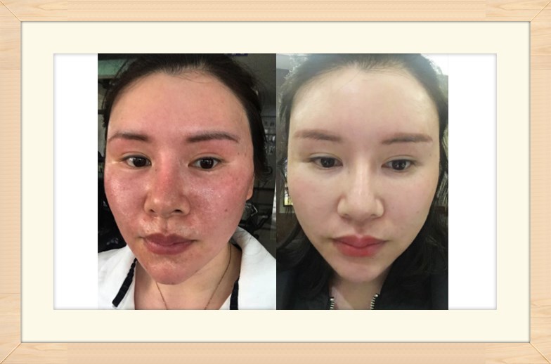 化妝品加工廠告訴你使用化妝品過敏了怎么辦？