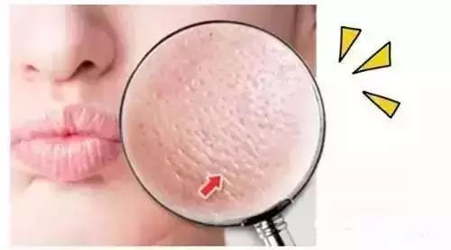 毛孔粗大怎么辦？毛孔粗大的解決方法