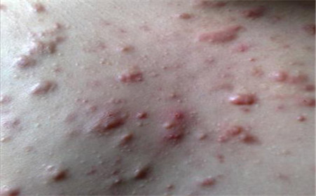 什么是痤瘡，什么是粉刺？痤瘡和粉刺有啥區(qū)別？