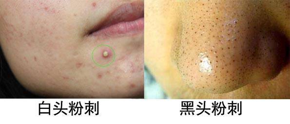 什么是痤瘡，什么是粉刺？痤瘡和粉刺有啥區(qū)別？